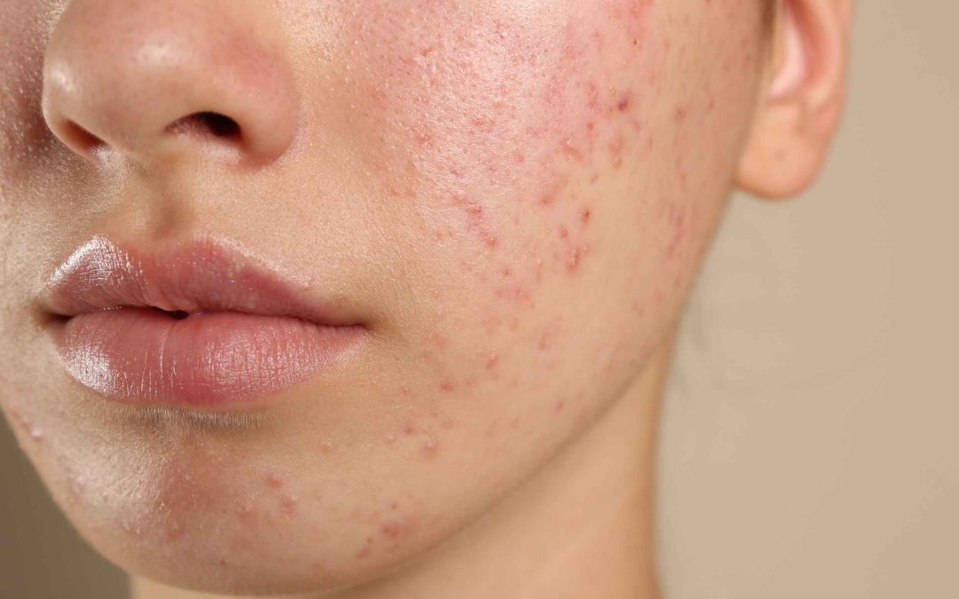 Masna koža i akne: Kako postići blistavu kožu prema savjetima farmaceuta i dermatologa