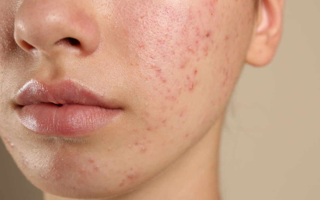 Masna koža i akne: Kako postići blistavnu kožu prema savjetima farmaceuta i dermatologa