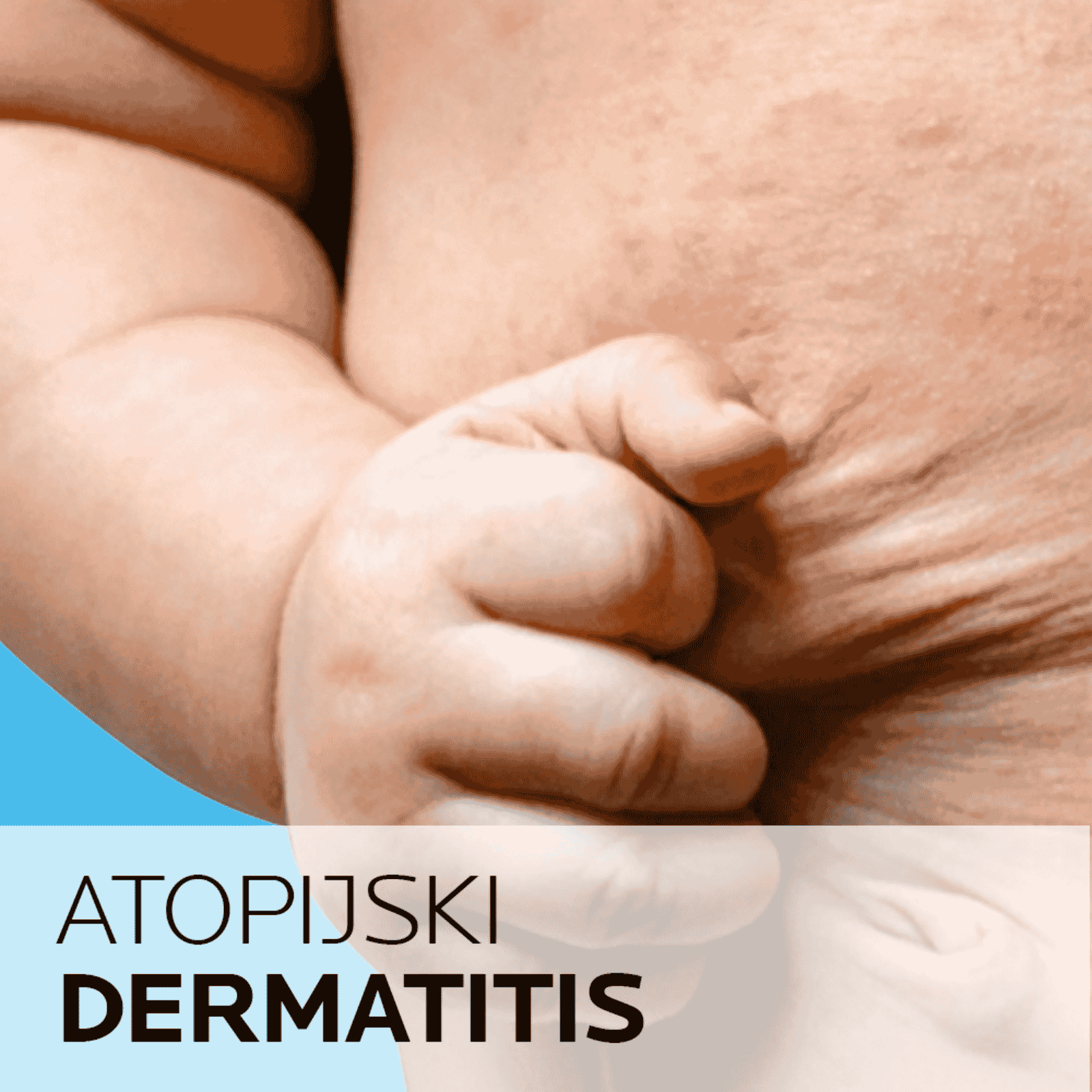 Atopijski dermatitis